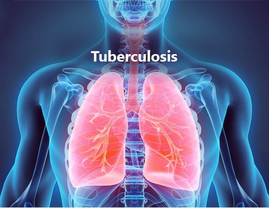 Basics of Tuberclosis